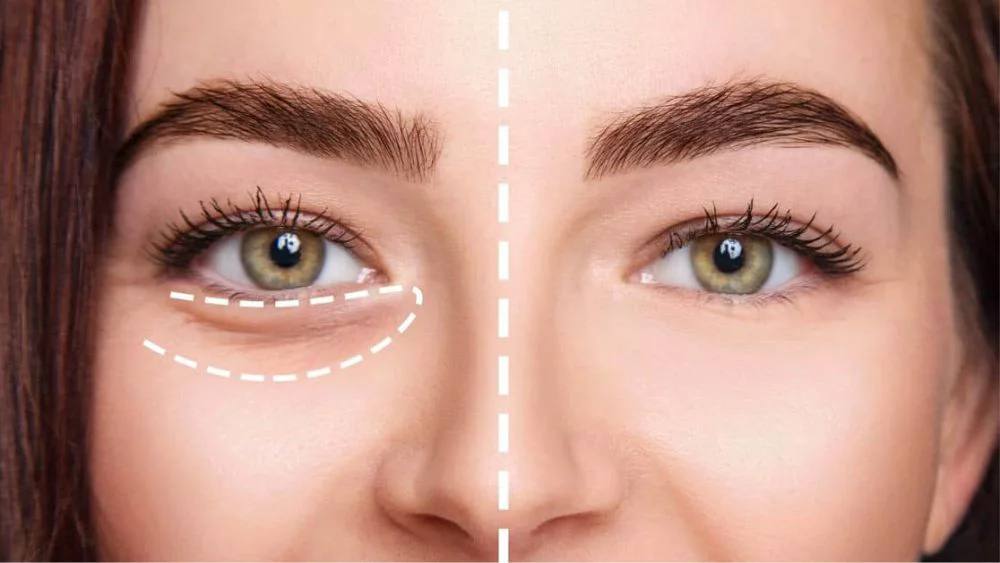 Tear Trough Filler (Under-Eye Light Filler)