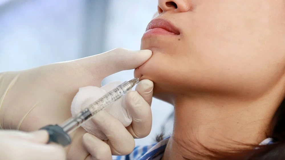 Jawline Filler