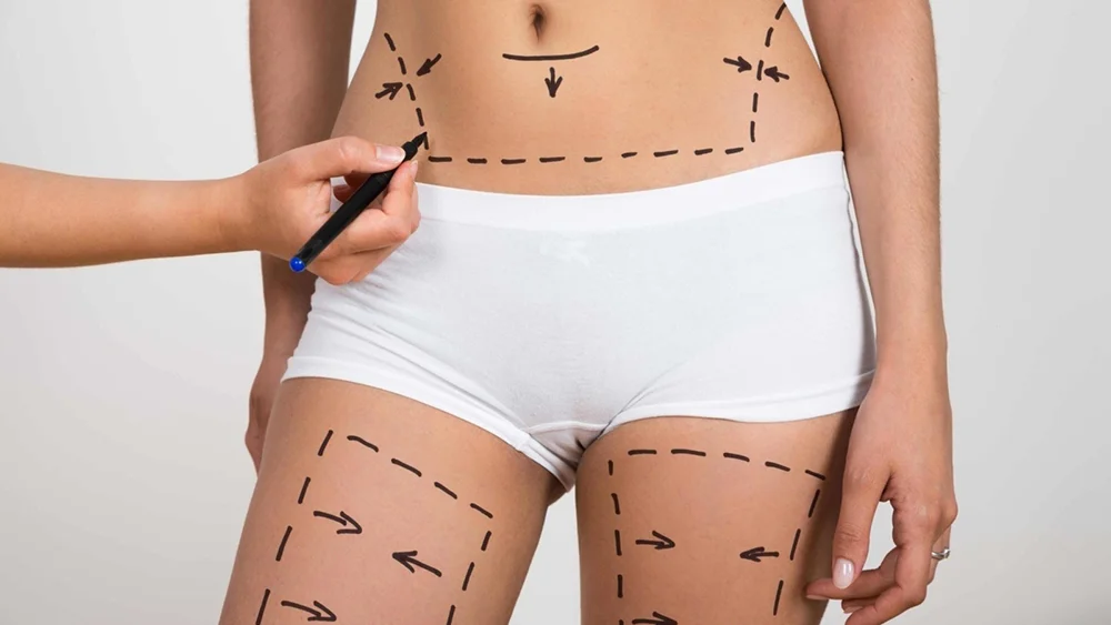 Liposuction (Fat Removal Surgery)