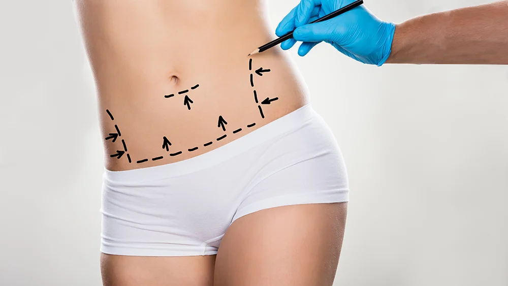 Abdominoplasty (TummyTuck)